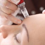 mesotherapy for acne scars