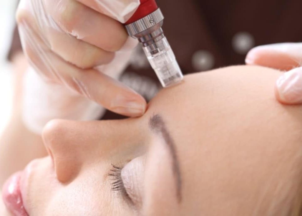 mesotherapy for acne scars