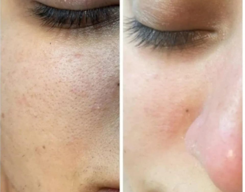 blacktown skin tightening