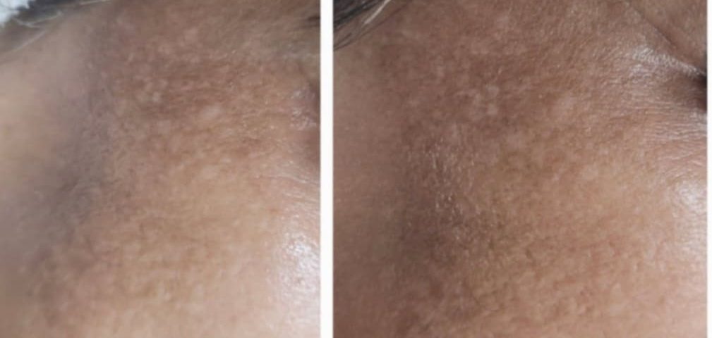 microneedling services baulkham hill