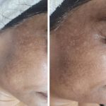 microneedling services baulkham hill
