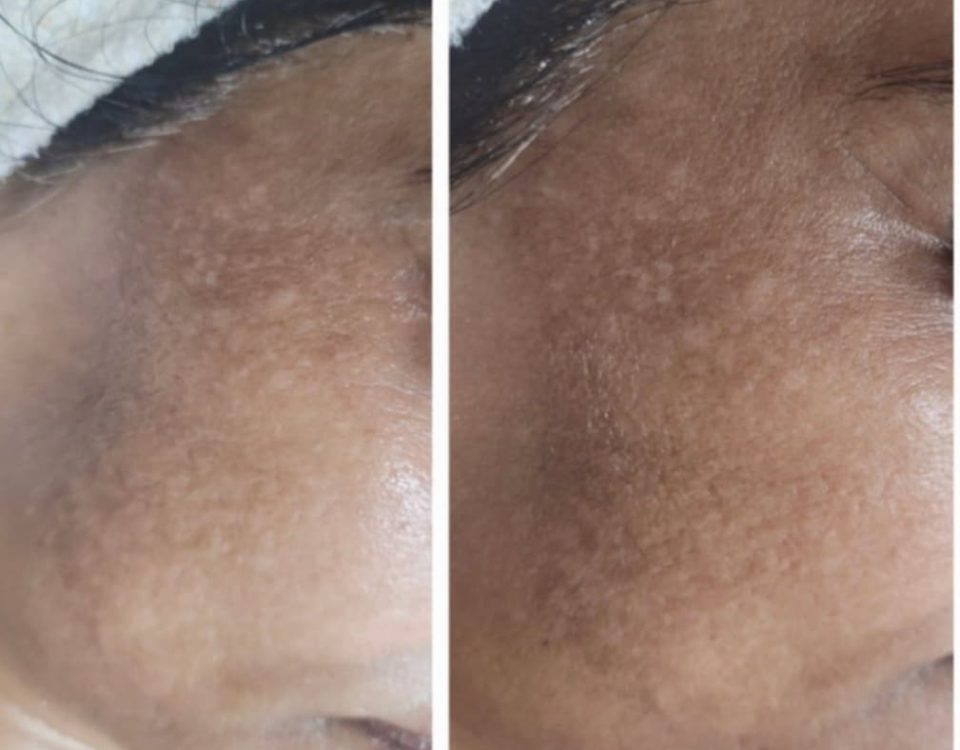microneedling services baulkham hill