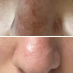 chemical peel blacktown