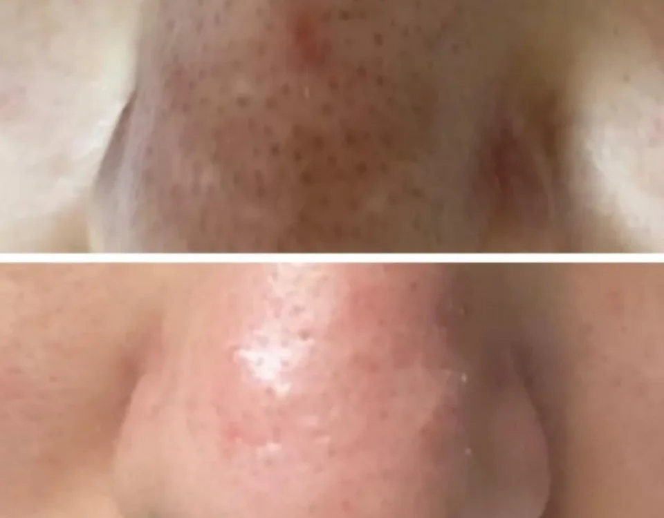 chemical peel blacktown