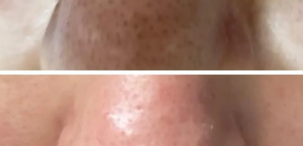 chemical peel blacktown